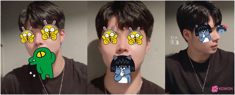논현동성형외과 남자복코 자가 늑연골 연장 수술 사진 7