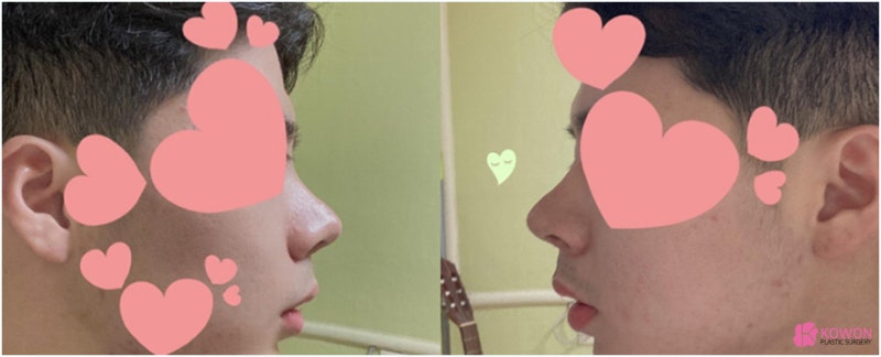 논현동성형외과 남자복코 자가 늑연골 연장 수술 사진 6