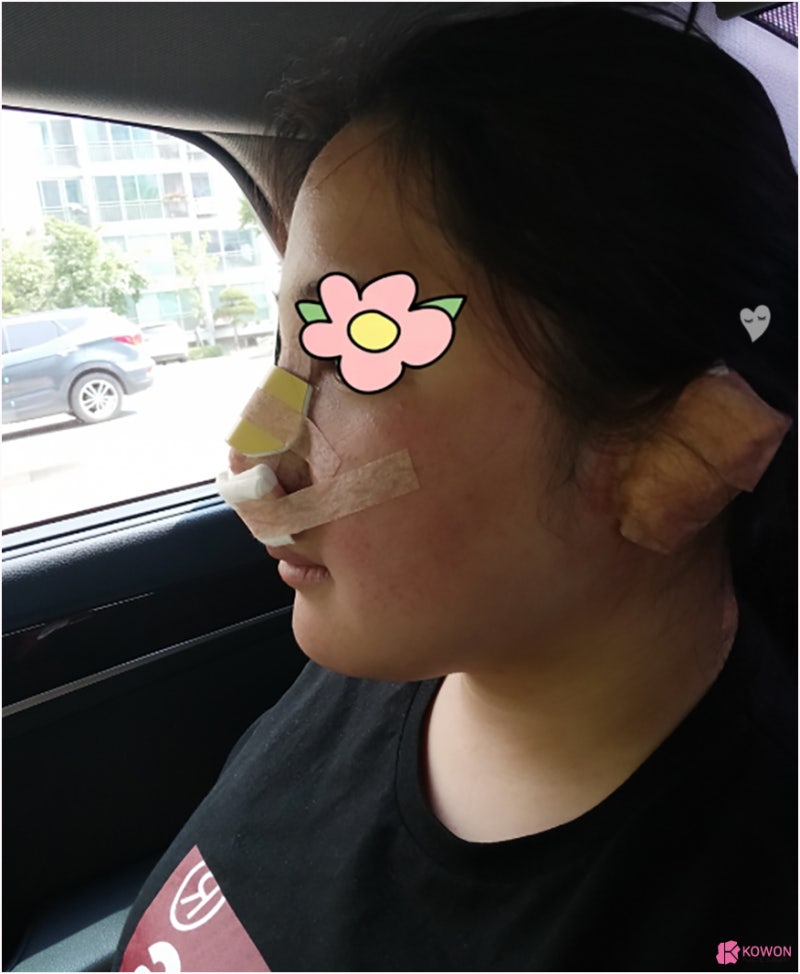 반포성형외과 콤플렉스 해결한 복코수술후기 사진 7