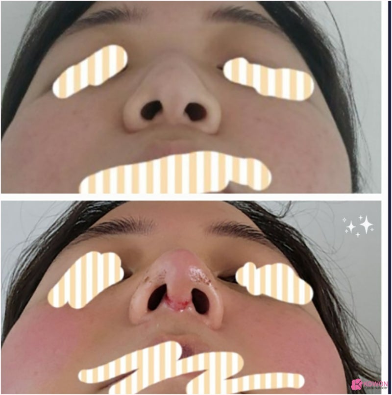 반포성형외과 콤플렉스 해결한 복코수술후기 사진 12