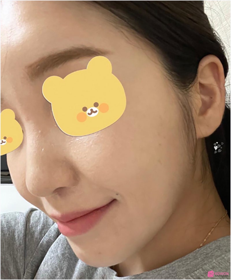 압구정동성형외과 동글코 개선 후 고급스러운 인상 사진 3
