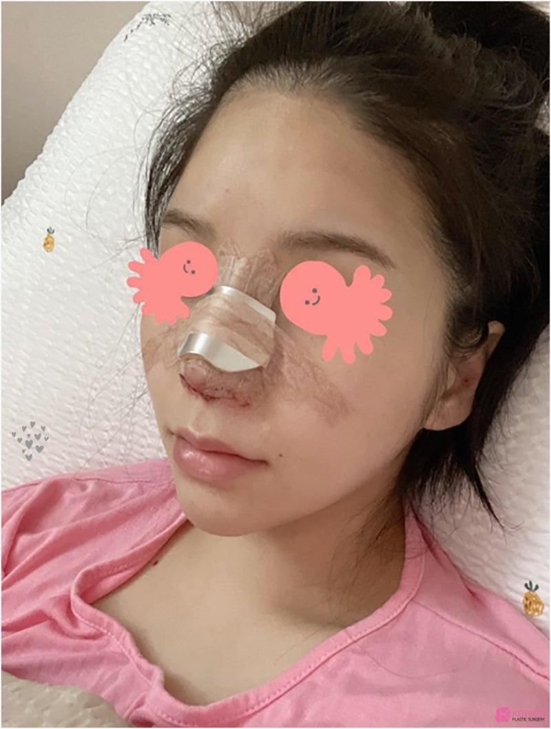 압구정동성형외과 동글코 개선 후 고급스러운 인상 사진 6
