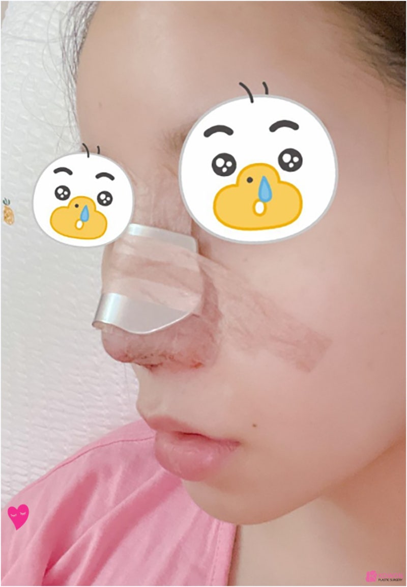 압구정동성형외과 동글코 개선 후 고급스러운 인상 사진 5