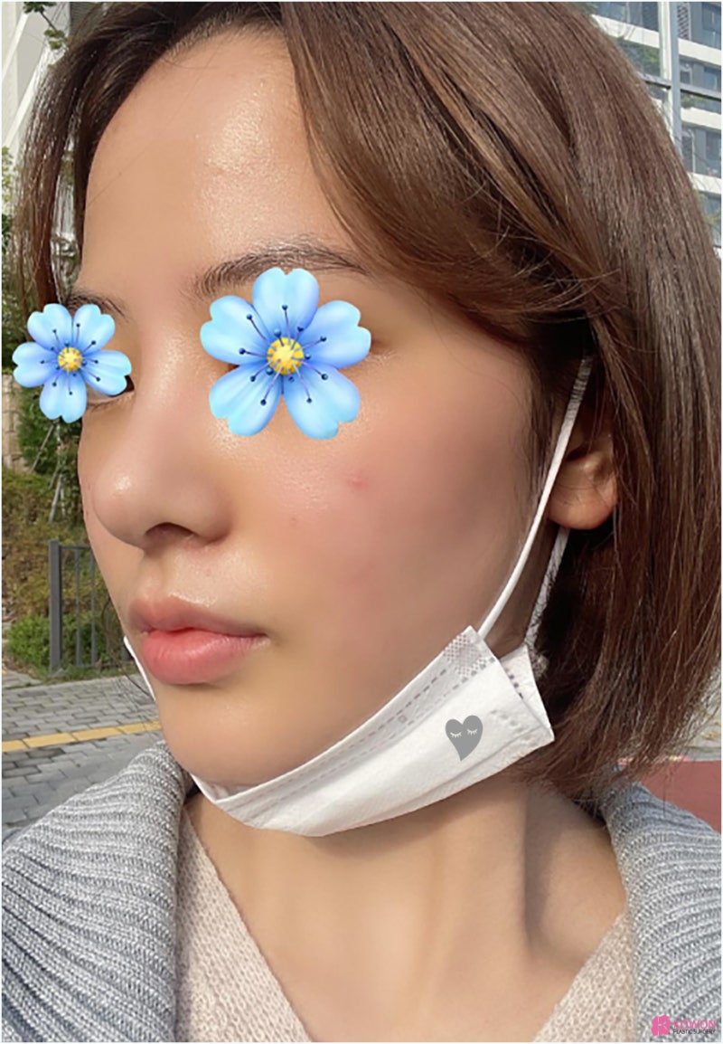 강남압구정성형외과 필러 제거 낮은콧대 수술 사진 9
