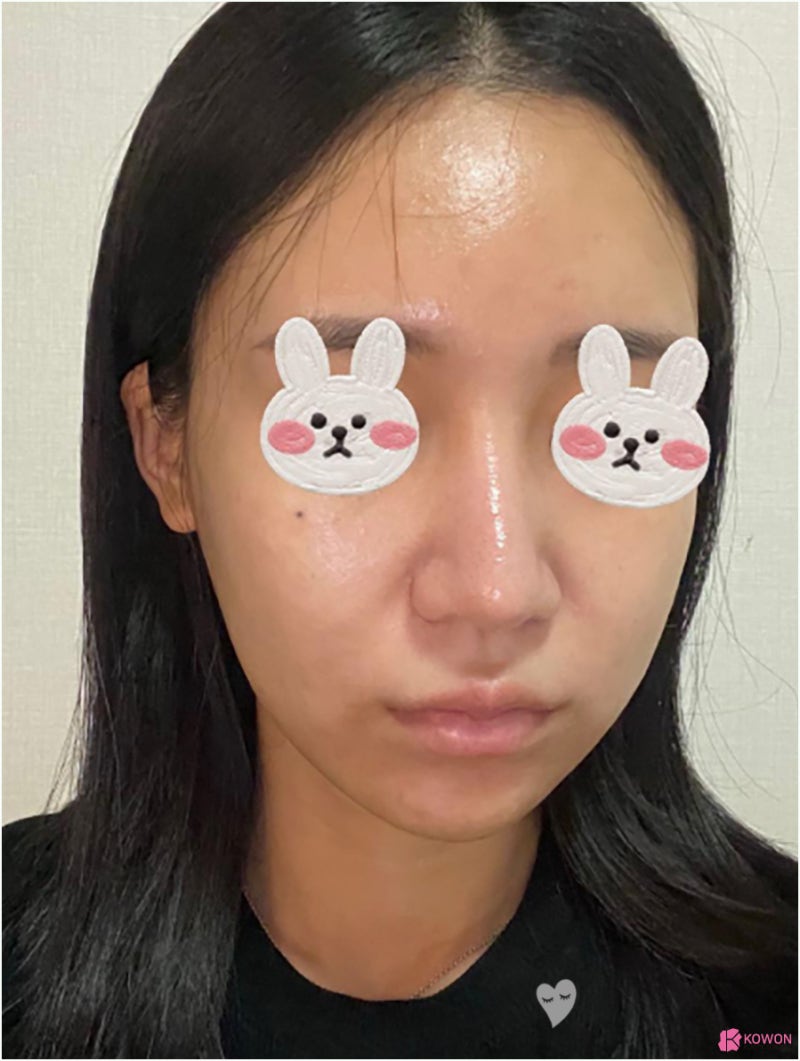 기능코성형외과 항생제 세파 알레르기 코끝높이기 사진 3