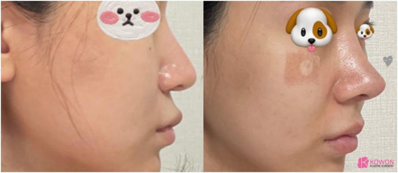 기능코성형외과 항생제 세파 알레르기 코끝높이기 사진 10