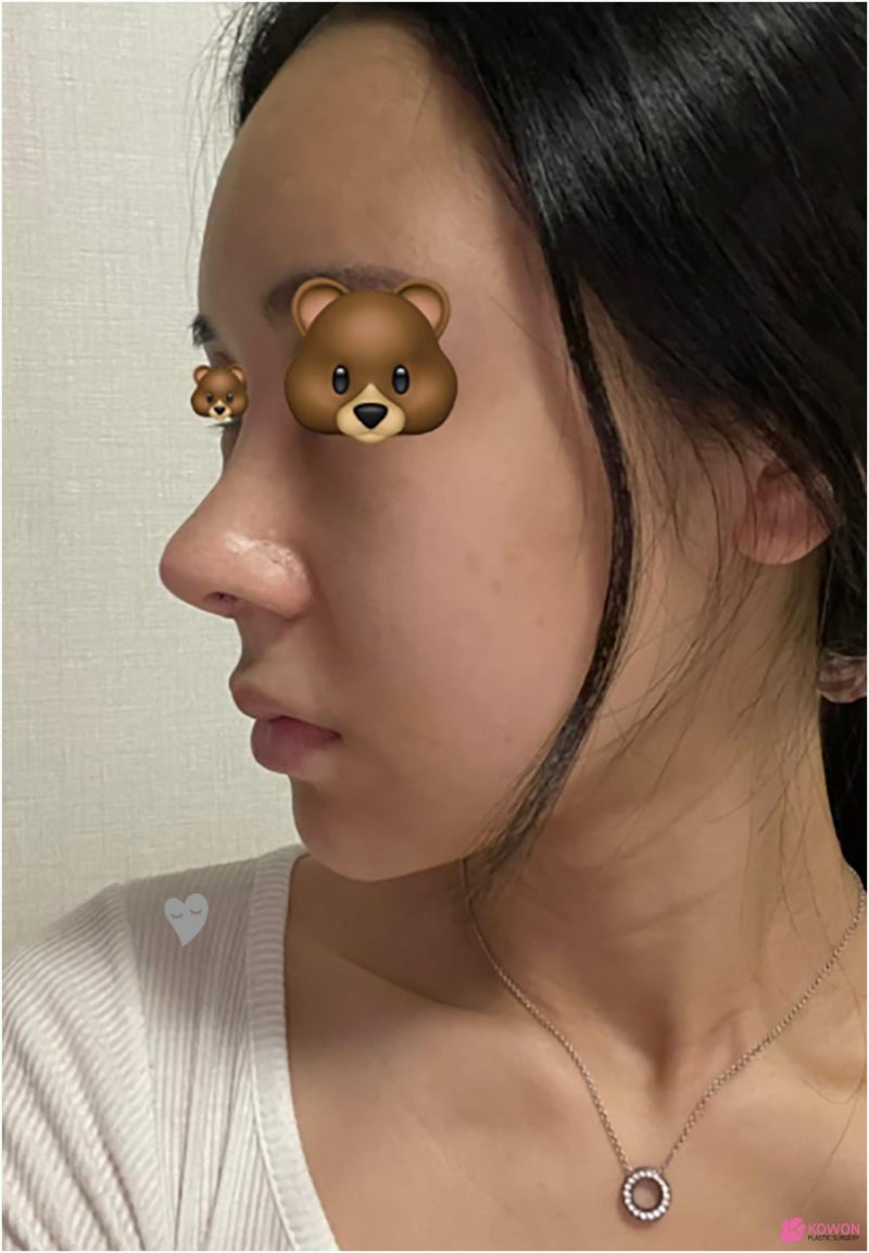 기능코성형외과 항생제 세파 알레르기 코끝높이기 사진 6