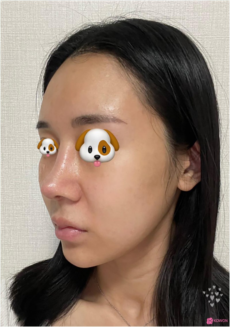 기능코성형외과 항생제 세파 알레르기 코끝높이기 사진 9