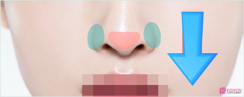 역삼동성형외과 코필러후수술 외모 불편함 해결