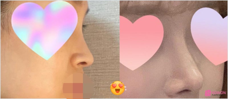 역삼동성형외과 코필러후수술 외모 불편함 해결 사진 11