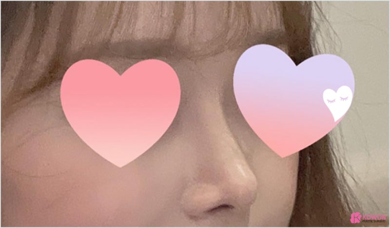 역삼동성형외과 코필러후수술 외모 불편함 해결
