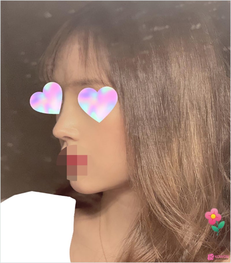 역삼동성형외과 코필러후수술 외모 불편함 해결 사진 7