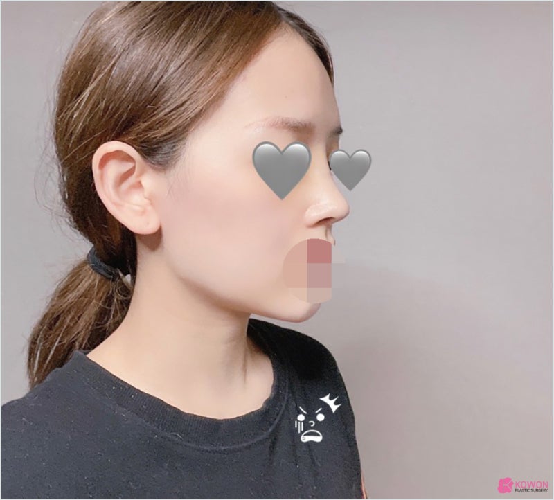 역삼동성형외과 코필러후수술 외모 불편함 해결 사진 4