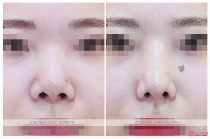 압구정로데오성형외과 자연스러운 자가 늑 짧은코연장수술