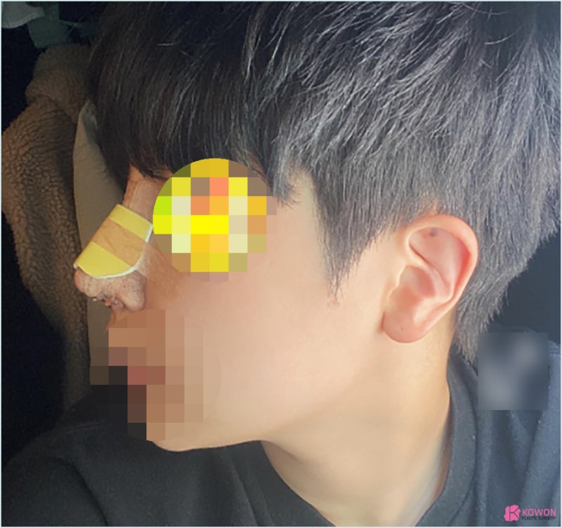 가로수길성형외과 코수술실리콘부작용 콧구멍 디자인 사진 6
