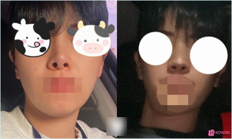 가로수길성형외과 코수술실리콘부작용 콧구멍 디자인