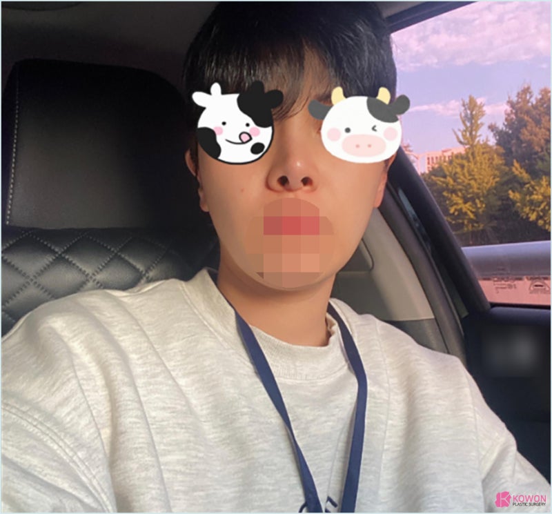 가로수길성형외과 코수술실리콘부작용 콧구멍 디자인
