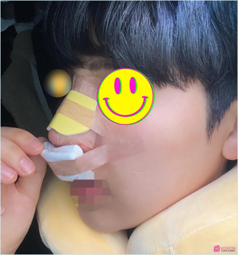 가로수길성형외과 코수술실리콘부작용 콧구멍 디자인 사진 5