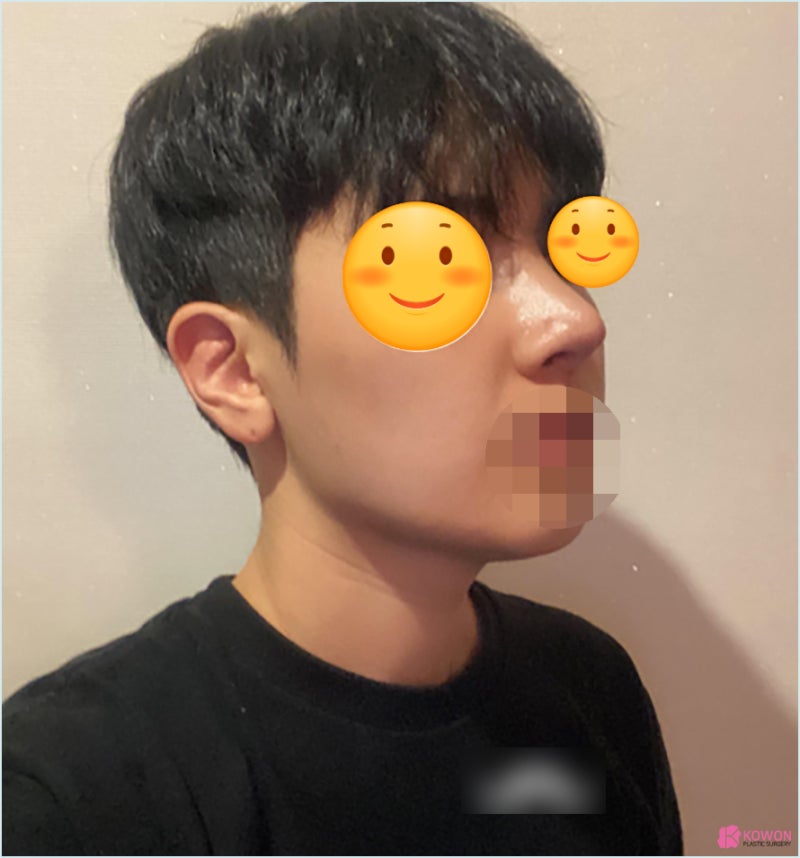 가로수길성형외과 코수술실리콘부작용 콧구멍 디자인 사진 10
