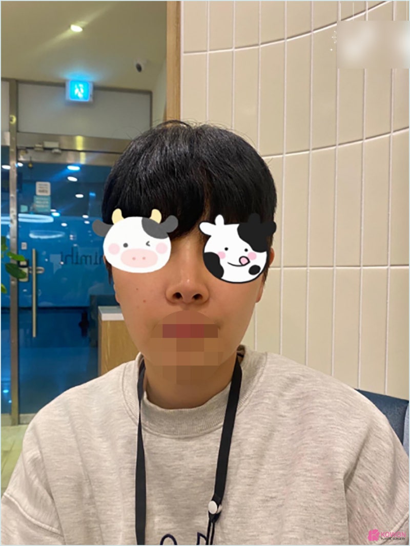 가로수길성형외과 코수술실리콘부작용 콧구멍 디자인 사진 3