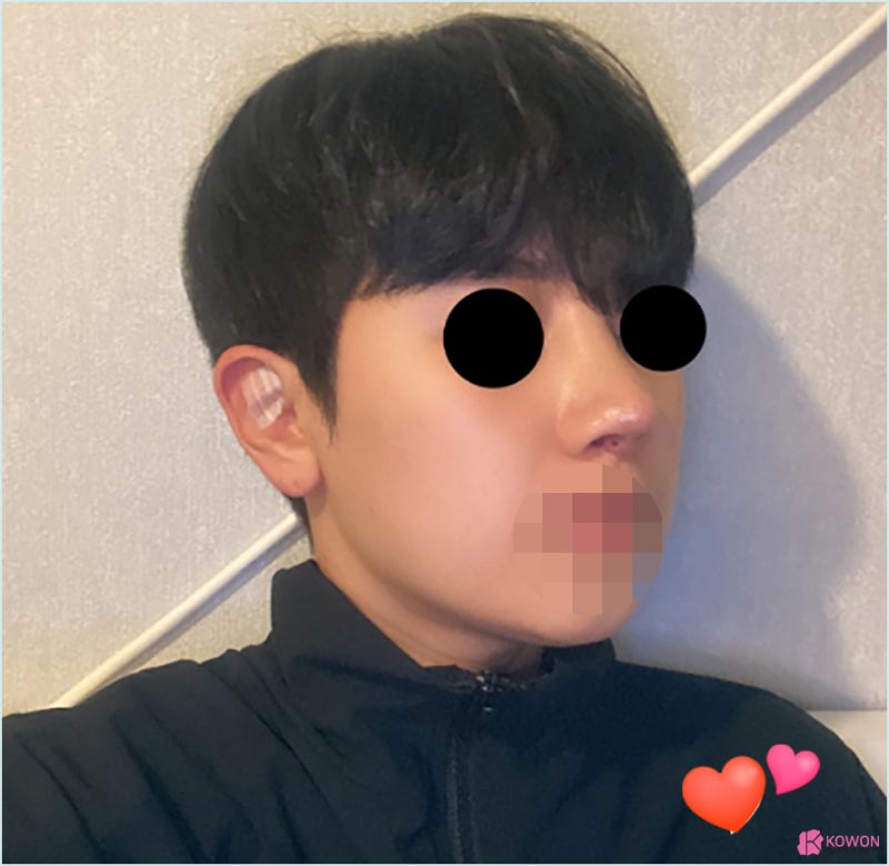 가로수길성형외과 코수술실리콘부작용 콧구멍 디자인 사진 7