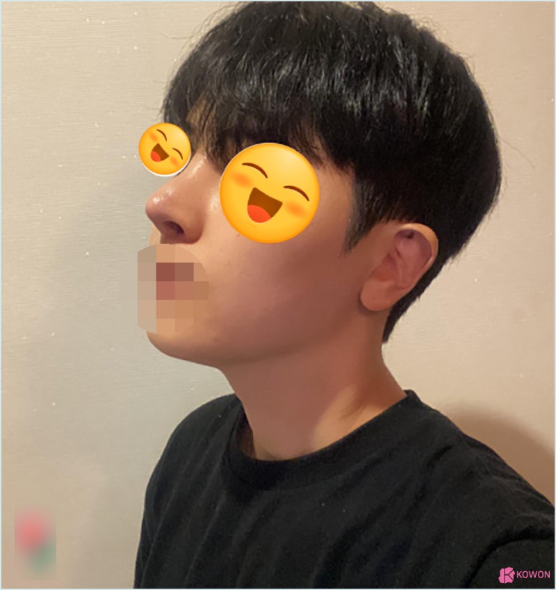 가로수길성형외과 코수술실리콘부작용 콧구멍 디자인 사진 11