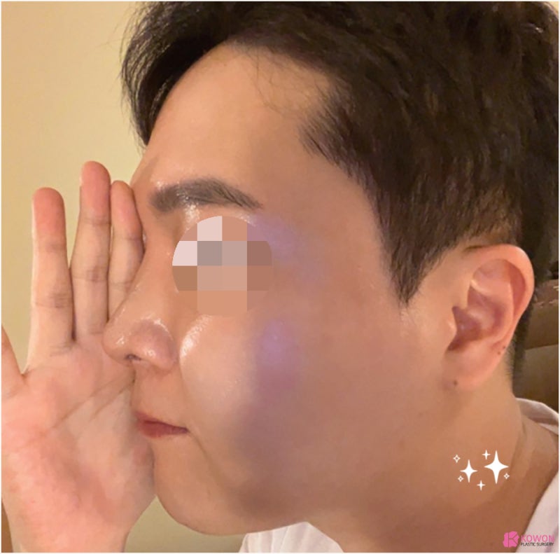 남자코성형외과 들창코수술전후 구축 이미지 개선 사진 8