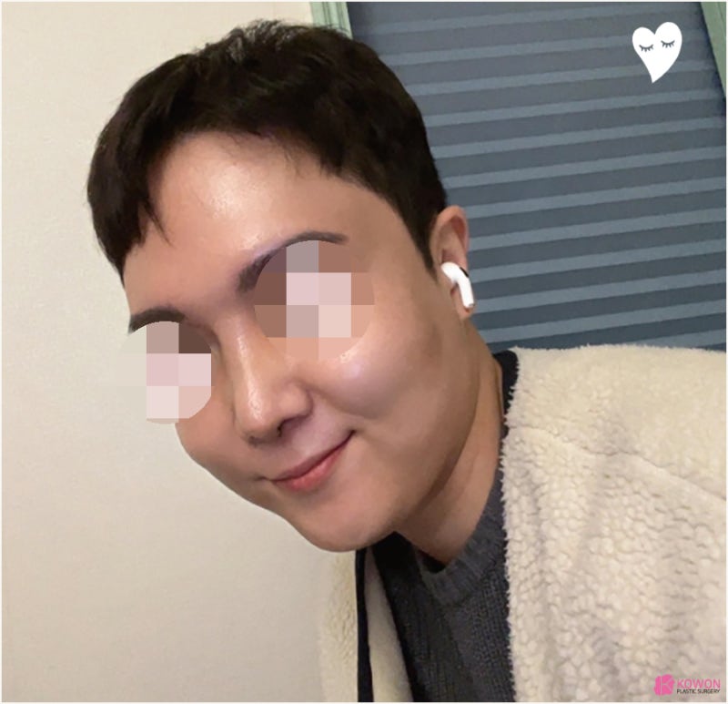남자코성형외과 들창코수술전후 구축 이미지 개선 사진 4