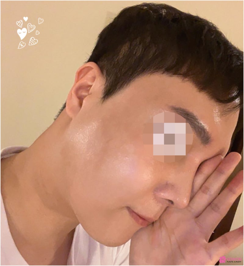 남자코성형외과 들창코수술전후 구축 이미지 개선 사진 7