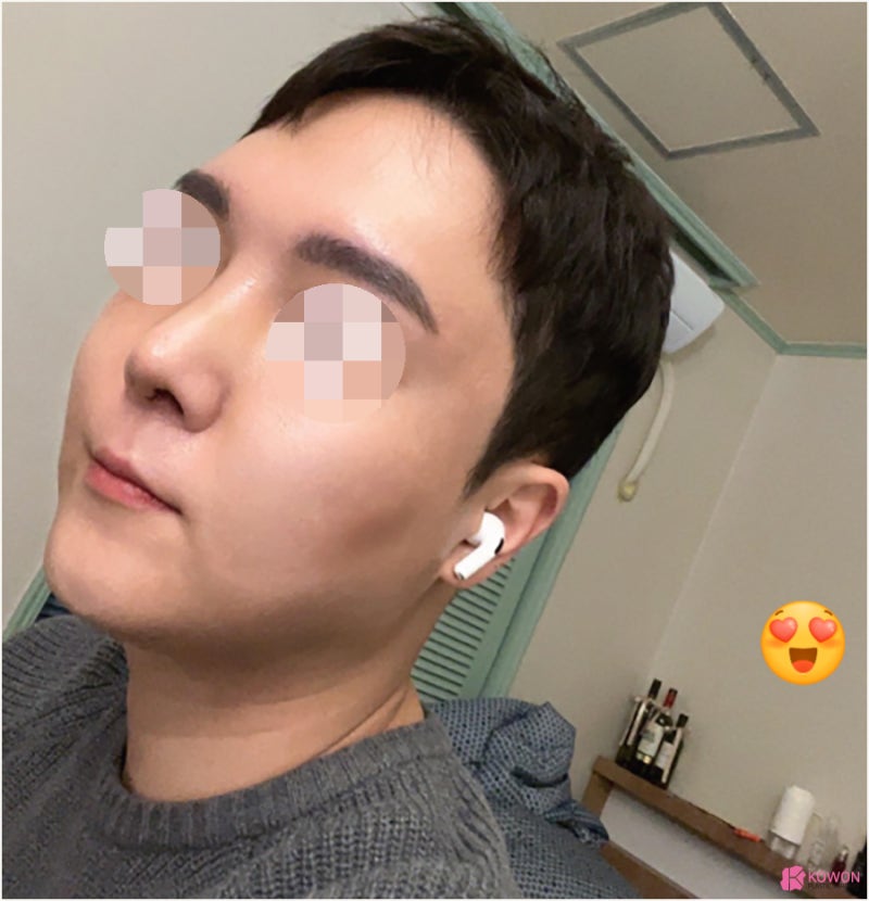 남자코성형외과 들창코수술전후 구축 이미지 개선 사진 6