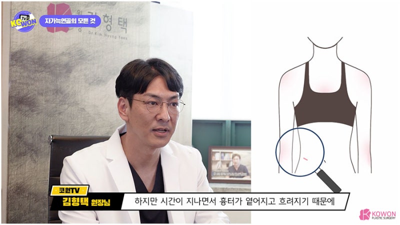 압구정성형외과수술후기 코연골휘어짐 수술 재료 장단점 사진 9