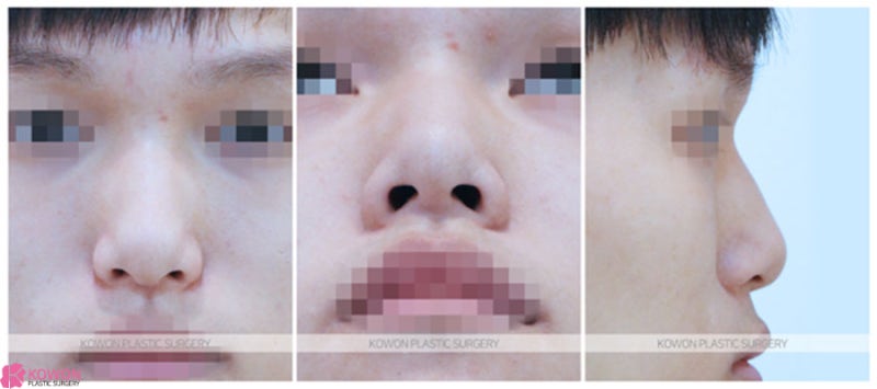 매부리코수술전후 낮은 미간 개선 신논현코성형외과 사진 2