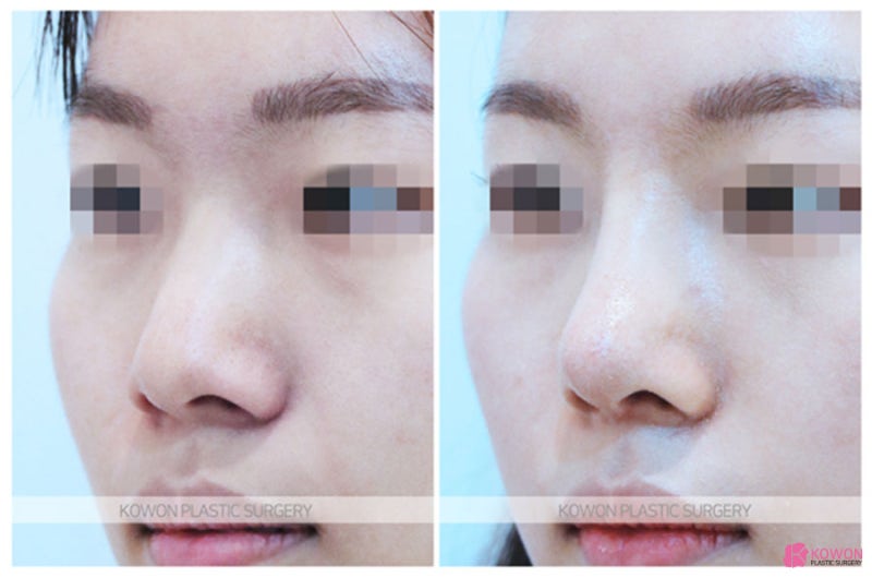 복코성형전후 넓은 콧구멍 신사역코성형외과 사진 5