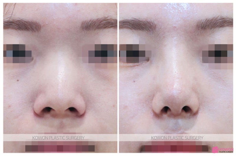 복코성형전후 넓은 콧구멍 신사역코성형외과 사진 7