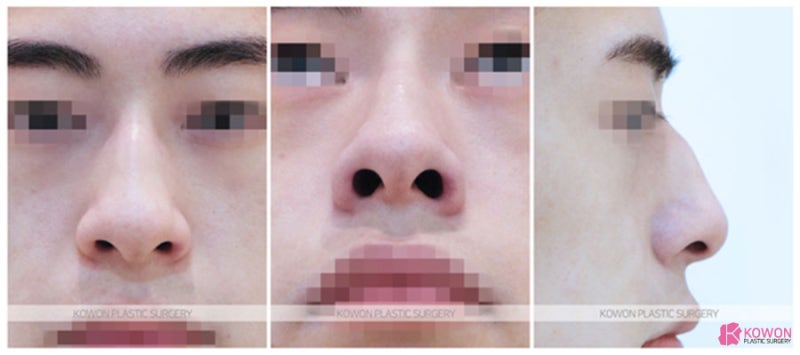 신사동코성형외과 휜코수술후기 뼈 이식 무보형물 사진 2