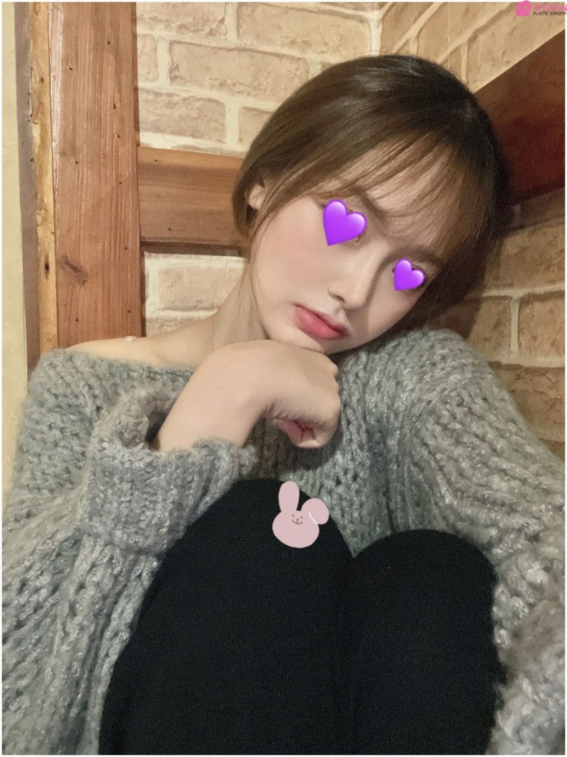 화살코 콤플렉스 해결 여성 환자 청담역성형외과 사진 8