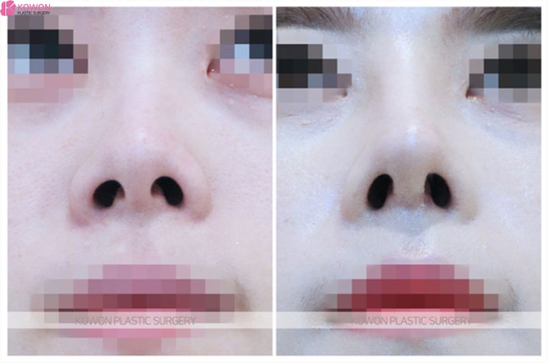 코재수술성형외과추천 콧구멍비대칭 짝짝이 개선 사진 5