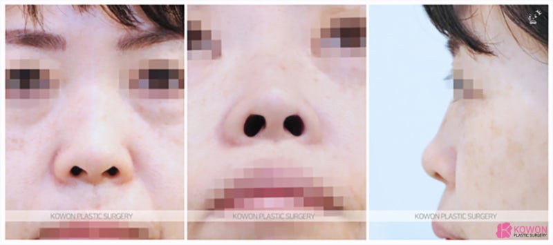 청담동성형외과 짧은코 여성스러운 느낌의 콧대 사진 2