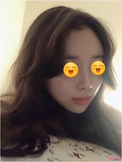 논현성형외과 작은코성형후기 종류 모양 이미지 사진 7