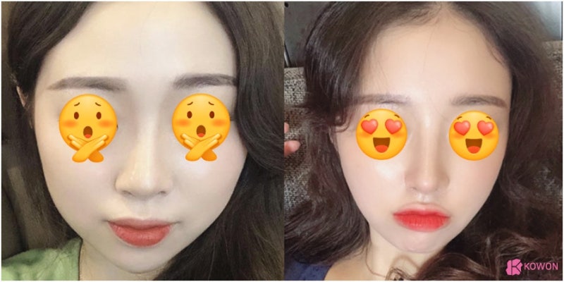 논현성형외과 작은코성형후기 종류 모양 이미지