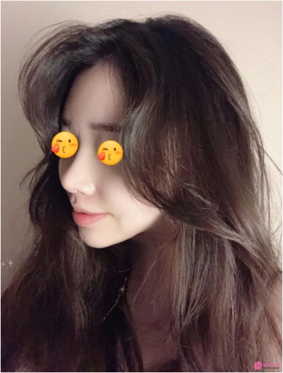 논현성형외과 작은코성형후기 종류 모양 이미지 사진 8