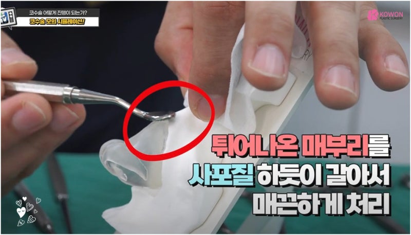 매부리코성형후기 코연골 콧대 높이 실리콘 절개 흉터 사진 3