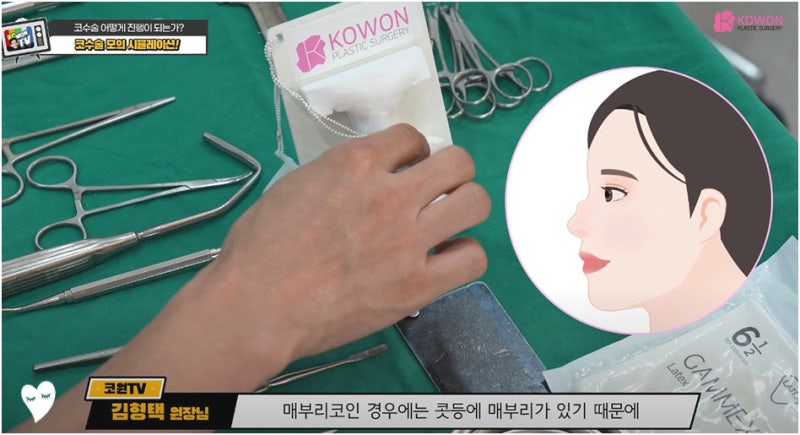 매부리코성형후기 코연골 콧대 높이 실리콘 절개 흉터 사진 9