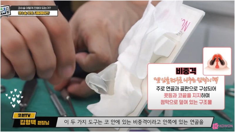 매부리코성형후기 코연골 콧대 높이 실리콘 절개 흉터