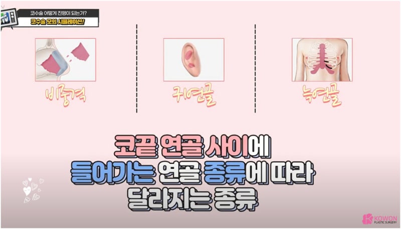 매부리코성형후기 코연골 콧대 높이 실리콘 절개 흉터 사진 6