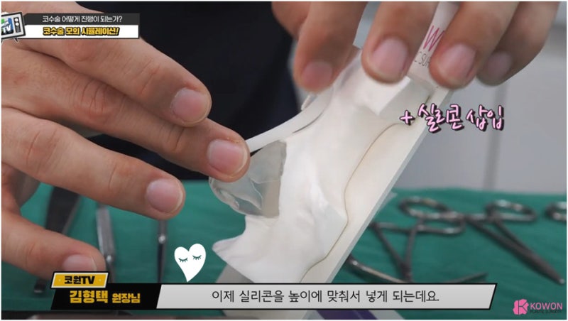 매부리코성형후기 코연골 콧대 높이 실리콘 절개 흉터 사진 5