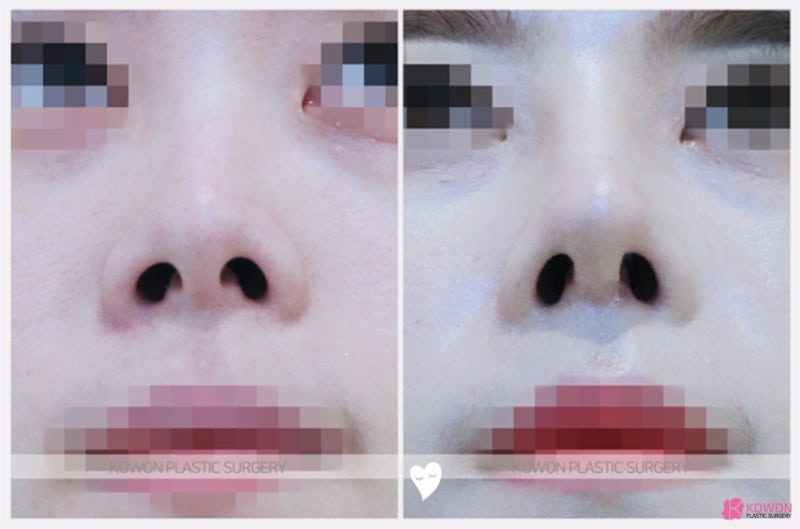강남성형외과유명한곳 콧구멍비대칭수술 실리콘 연골 사진 6