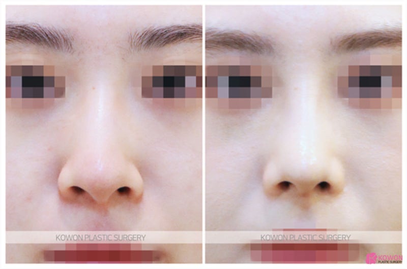 퍼진코 모으는 개선 방법 무보형물코성형후기 사진 6
