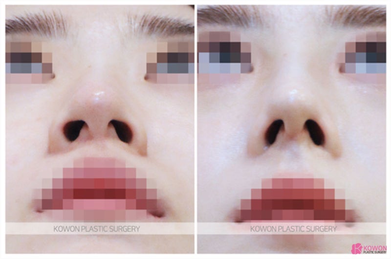 퍼진코 모으는 개선 방법 무보형물코성형후기 사진 5