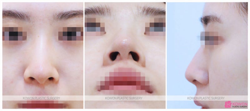 퍼진코 모으는 개선 방법 무보형물코성형후기 사진 2